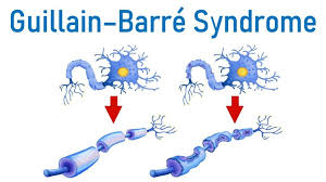 Medications for Guillain-Barré Syndrome: Promoting Recovery and Relieving Symptoms post thumbnail image