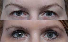 Awaken Your Gaze: Exploring the Best Blepharoplasty in Santa Barbara post thumbnail image