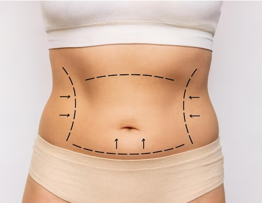 Eternal Elegance: The Pinnacle of Abdominoplasty Beauty in Miami post thumbnail image